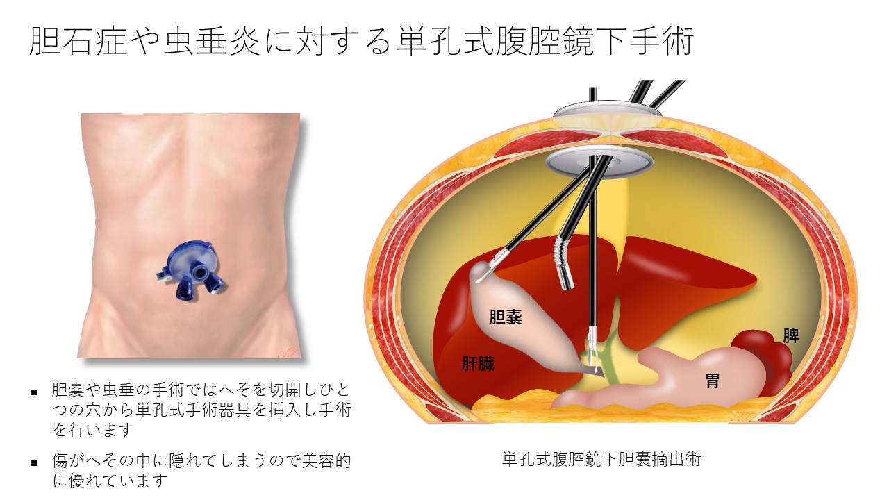 へそ 腹腔 鏡 手術